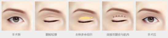 双眼皮手术恢复过程
