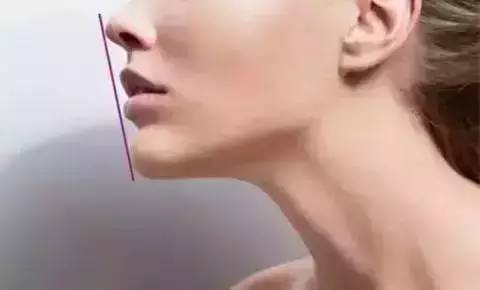 玻尿酸注射后注意事项 玻尿酸注射下巴后注意事项