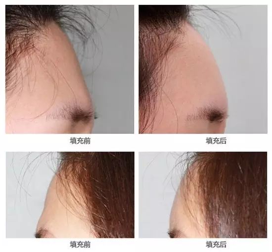 自体脂肪填充面部凹陷